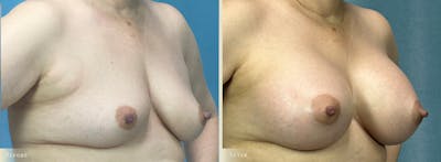 Breast Augmentation Before & After Gallery - Patient 110276 - Image 2