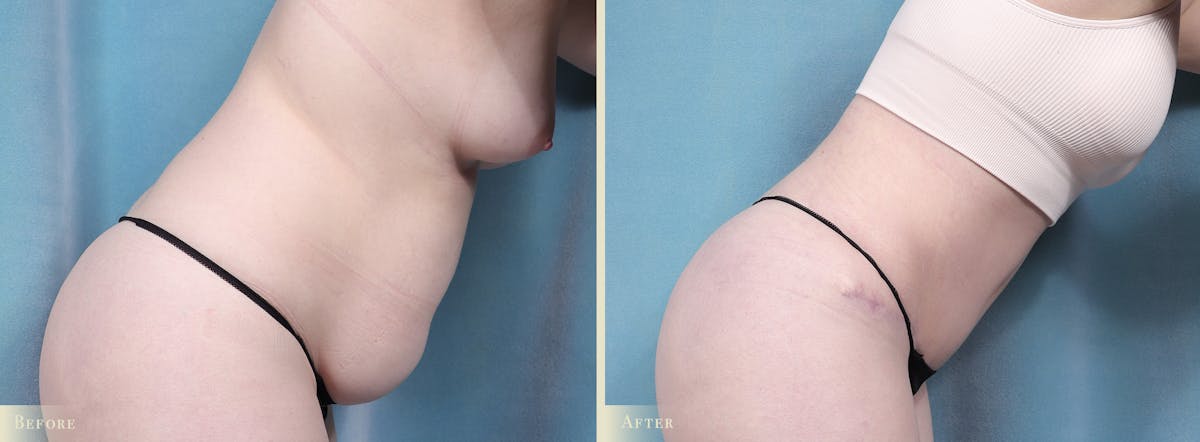 Tummy Tuck Before & After Gallery - Patient 329826 - Image 3