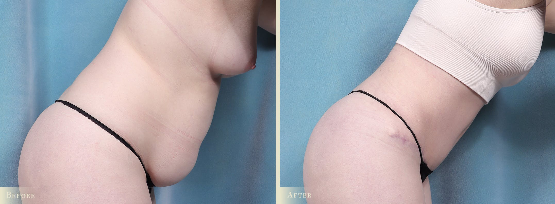 Tummy Tuck Before & After Gallery - Patient 329826 - Image 3