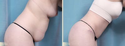 Tummy Tuck Before & After Gallery - Patient 329826 - Image 3