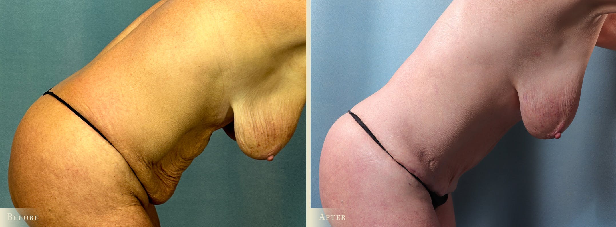 Tummy Tuck Before & After Gallery - Patient 417453 - Image 3