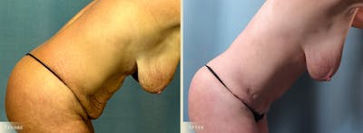 Tummy Tuck Before & After Gallery - Patient 417453 - Image 3