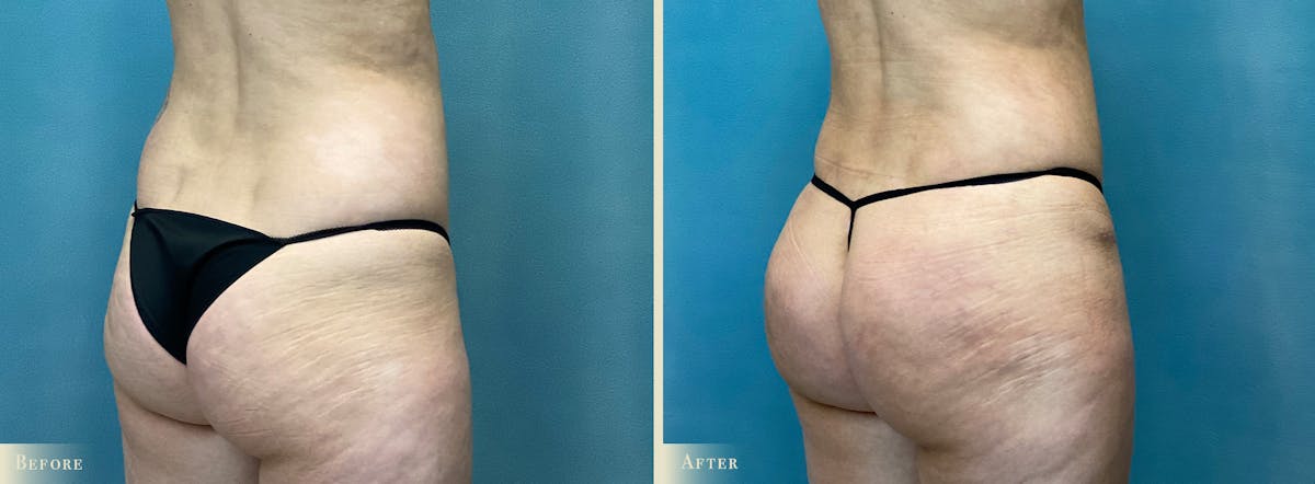 Brazilian Butt Lift Before & After Gallery - Patient 659667 - Image 2