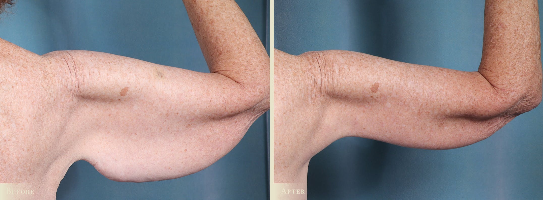Arm Lift Before & After Gallery - Patient 149710 - Image 1