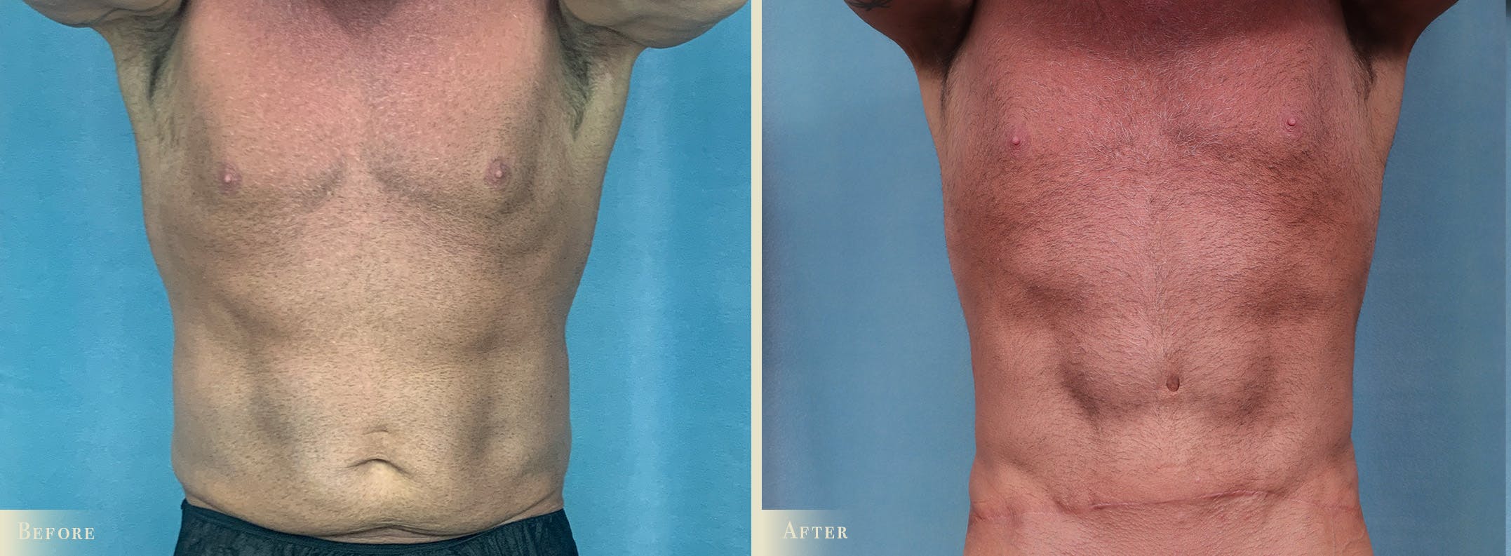 Tummy Tuck Before & After Gallery - Patient 423154 - Image 1