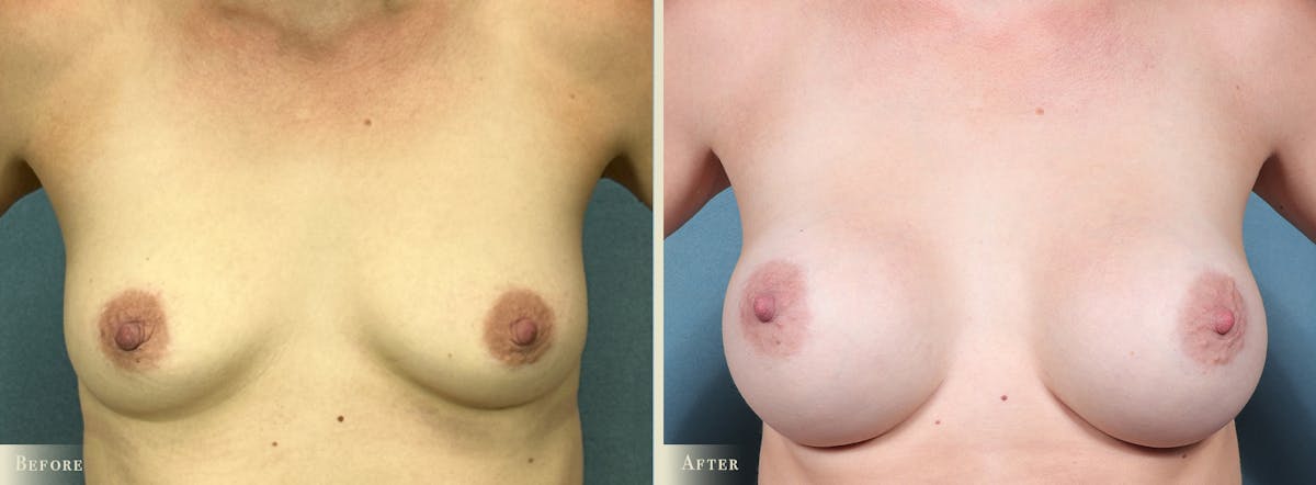Breast Augmentation Before & After Gallery - Patient 116112 - Image 1