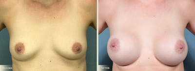 Breast Augmentation Before & After Gallery - Patient 116112 - Image 1