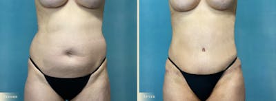 Brazilian Butt Lift Before & After Gallery - Patient 659667 - Image 5