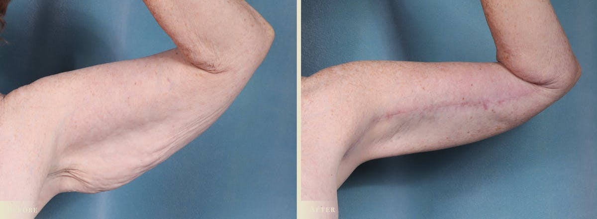 Arm Lift Before & After Gallery - Patient 149710 - Image 2