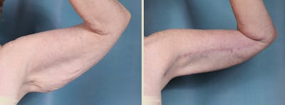 Arm Lift Before & After Gallery - Patient 149710 - Image 2