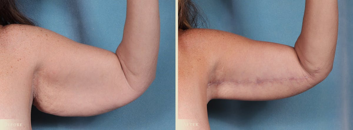 Arm Lift Before & After Gallery - Patient 891604 - Image 4