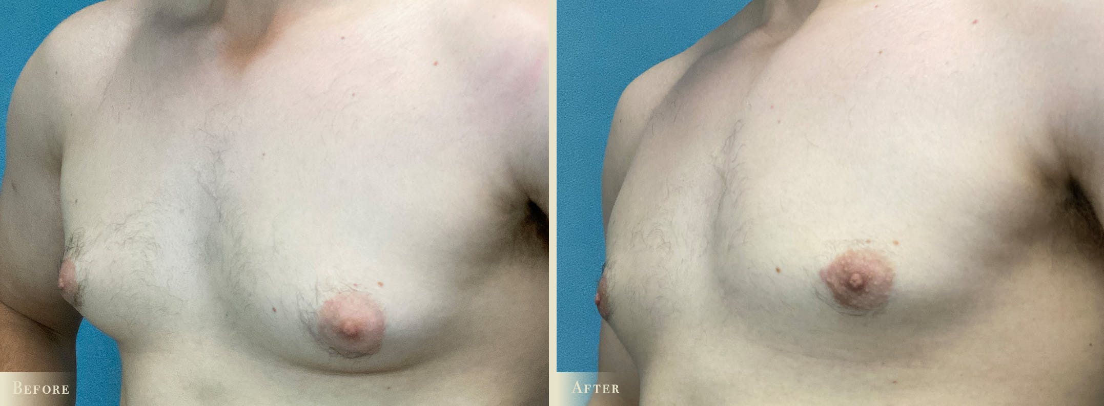 Male Breast Reduction (Gynecomastia) Before & After Gallery - Patient 184612 - Image 2