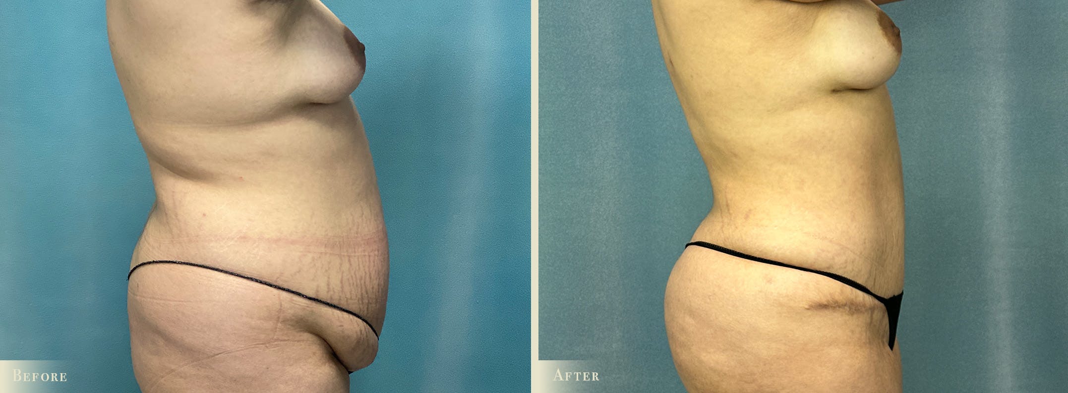 Tummy Tuck Before & After Gallery - Patient 141256 - Image 2
