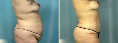 Tummy Tuck Before & After Gallery - Patient 141256 - Image 2