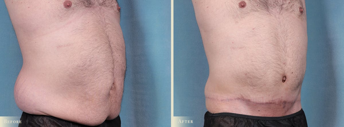 Tummy Tuck Before & After Gallery - Patient 374256 - Image 2