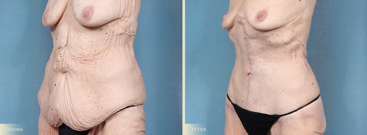 Tummy Tuck Before & After Gallery - Patient 115059 - Image 2