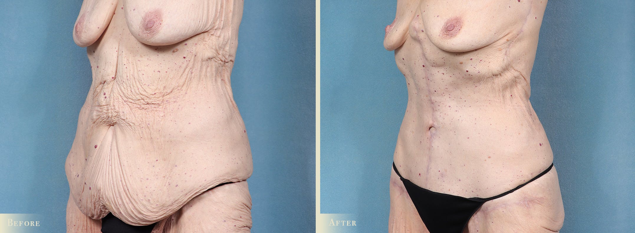 Tummy Tuck Before & After Gallery - Patient 115059 - Image 2