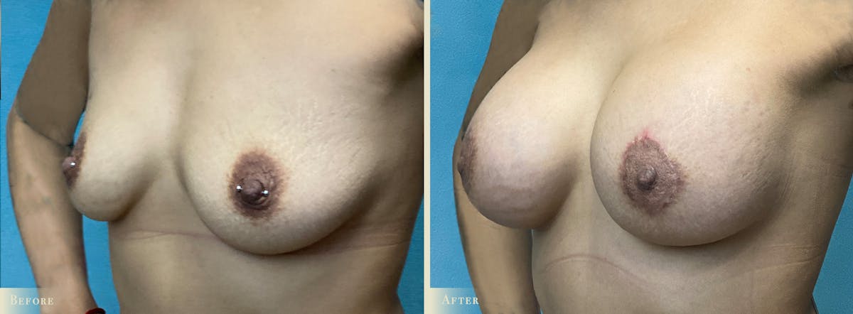 Breast Augmentation and Lift  Before & After Gallery - Patient 145424 - Image 2