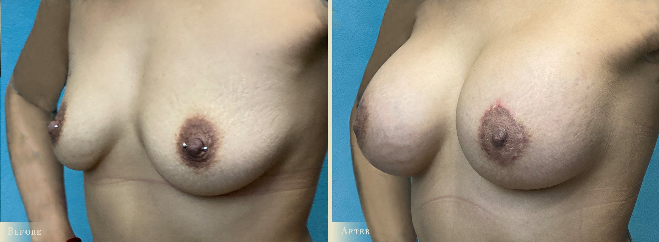 Breast Augmentation and Lift Before & After Gallery - Patient 145424 - Image 2