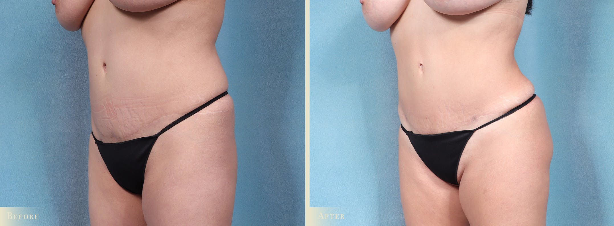 Brazilian Butt Lift Before & After Gallery - Patient 353945 - Image 3