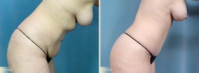 Tummy Tuck Before & After Gallery - Patient 371569 - Image 3
