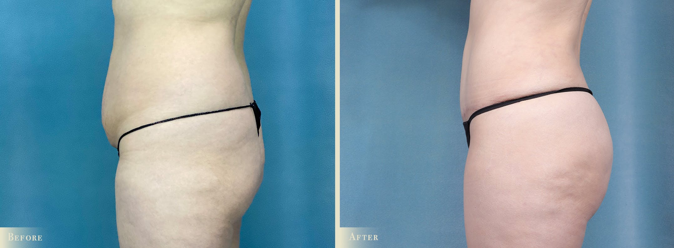 Brazilian Butt Lift Before & After Gallery - Patient 331180 - Image 3