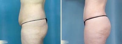 Brazilian Butt Lift Before & After Gallery - Patient 331180 - Image 3