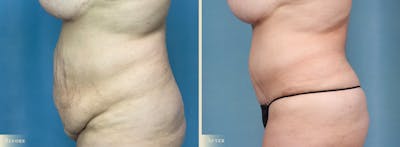 Tummy Tuck Before & After Gallery - Patient 602610 - Image 3