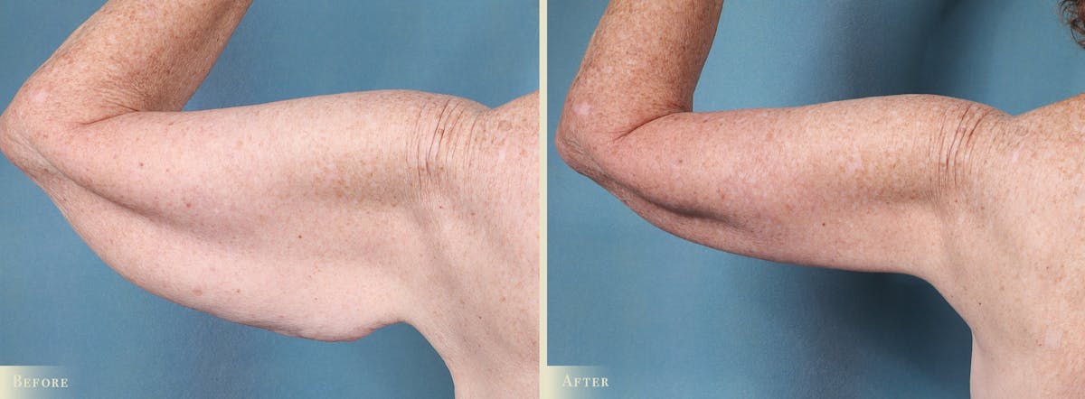 Arm Lift Before & After Gallery - Patient 149710 - Image 3
