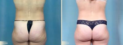 Tummy Tuck Before & After Gallery - Patient 700488 - Image 4