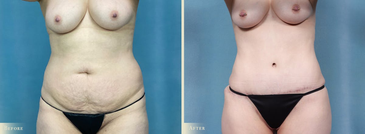 Tummy Tuck Before & After Gallery - Patient 371569 - Image 1