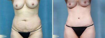 Tummy Tuck Before & After Gallery - Patient 371569 - Image 1