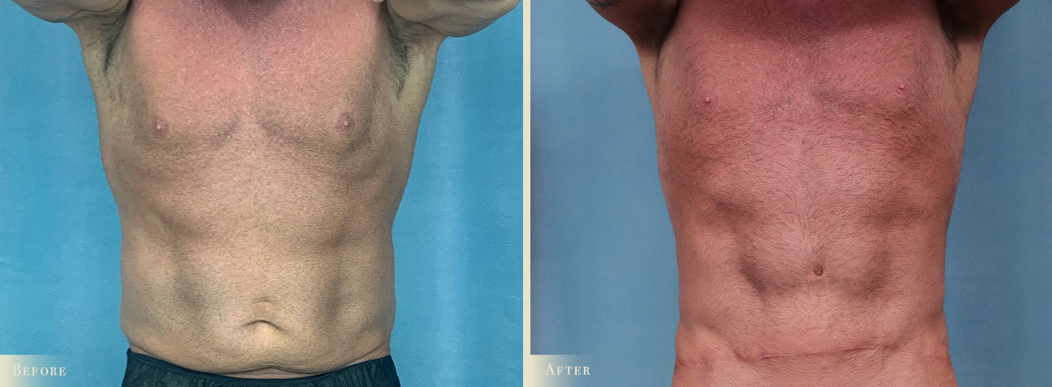 Male Tummy Tuck Before & After Gallery - Patient 383521 - Image 1