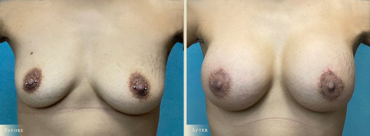 Breast Augmentation and Lift  Before & After Gallery - Patient 145424 - Image 1