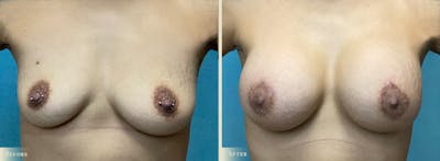 Breast Augmentation and Lift Before & After Gallery - Patient 145424 - Image 1