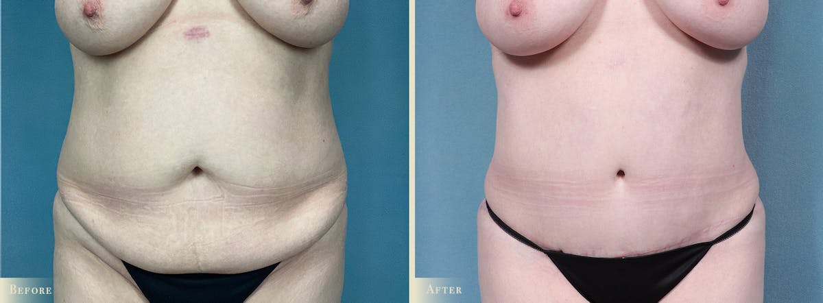 Tummy Tuck Before & After Gallery - Patient 205763 - Image 1