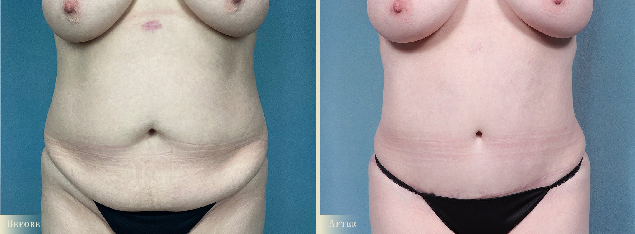 Tummy Tuck Before & After Gallery - Patient 205763 - Image 1