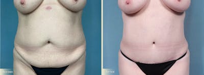 Tummy Tuck Before & After Gallery - Patient 205763 - Image 1