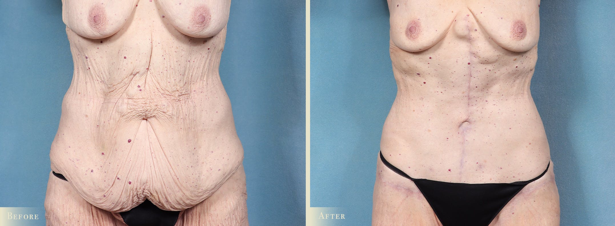 Tummy Tuck Before & After Gallery - Patient 115059 - Image 1