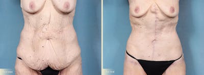 Tummy Tuck Before & After Gallery - Patient 115059 - Image 1