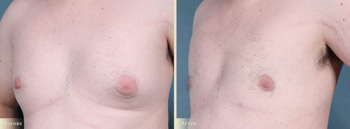 Male Breast Reduction (Gynecomastia) Before & After Gallery - Patient 141689 - Image 2