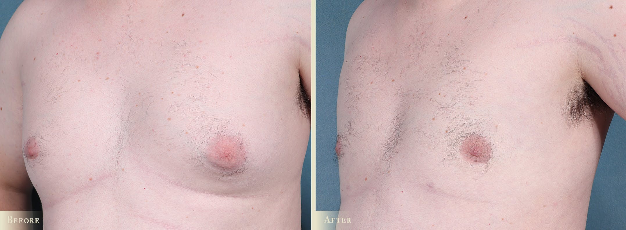 Male Breast Reduction (Gynecomastia) Before & After Gallery - Patient 141689 - Image 2