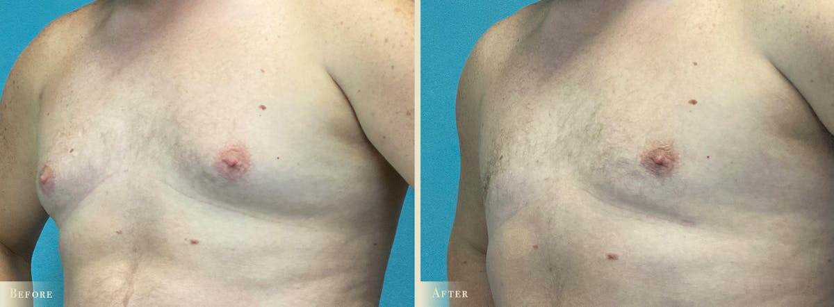 Male Breast Reduction (Gynecomastia) Before & After Gallery - Patient 362493 - Image 2