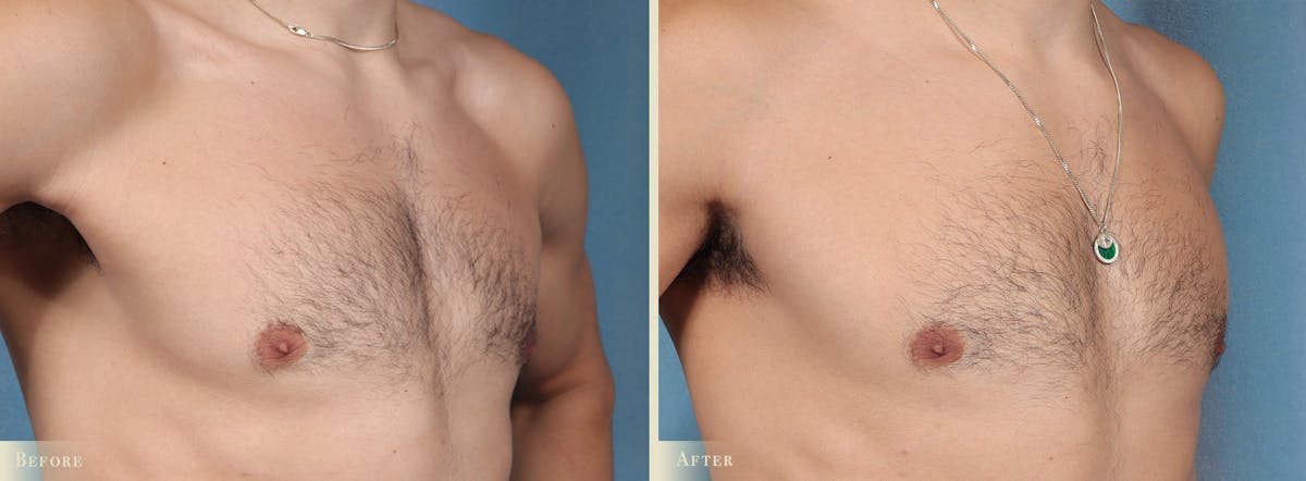 Male Breast Reduction (Gynecomastia) Before & After Gallery - Patient 101135 - Image 2