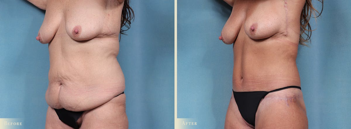 Body Lift Before & After Gallery - Patient 106276 - Image 2