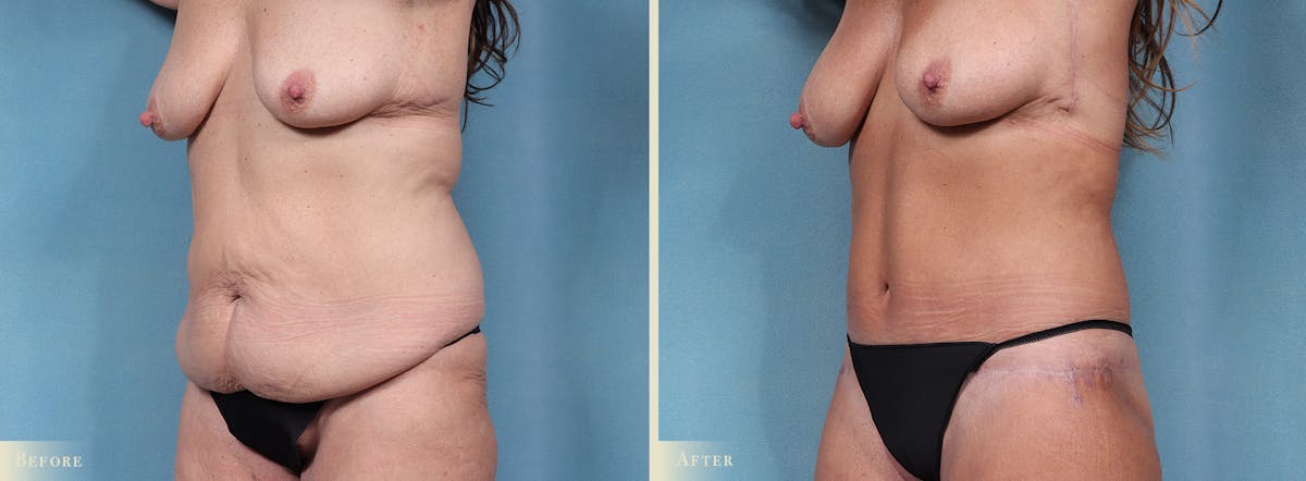 Weight Loss Body Contouring Combination Procedures Before & After Gallery - Patient 300614 - Image 2