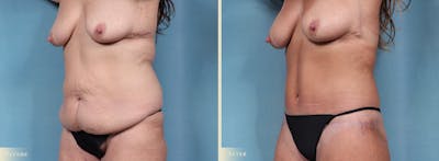 Weight Loss Body Contouring Combination Procedures Before & After Gallery - Patient 300614 - Image 2