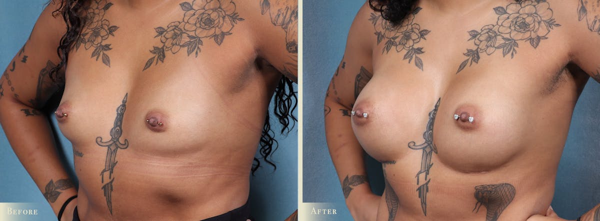 Breast Augmentation Before & After Gallery - Patient 127669 - Image 2