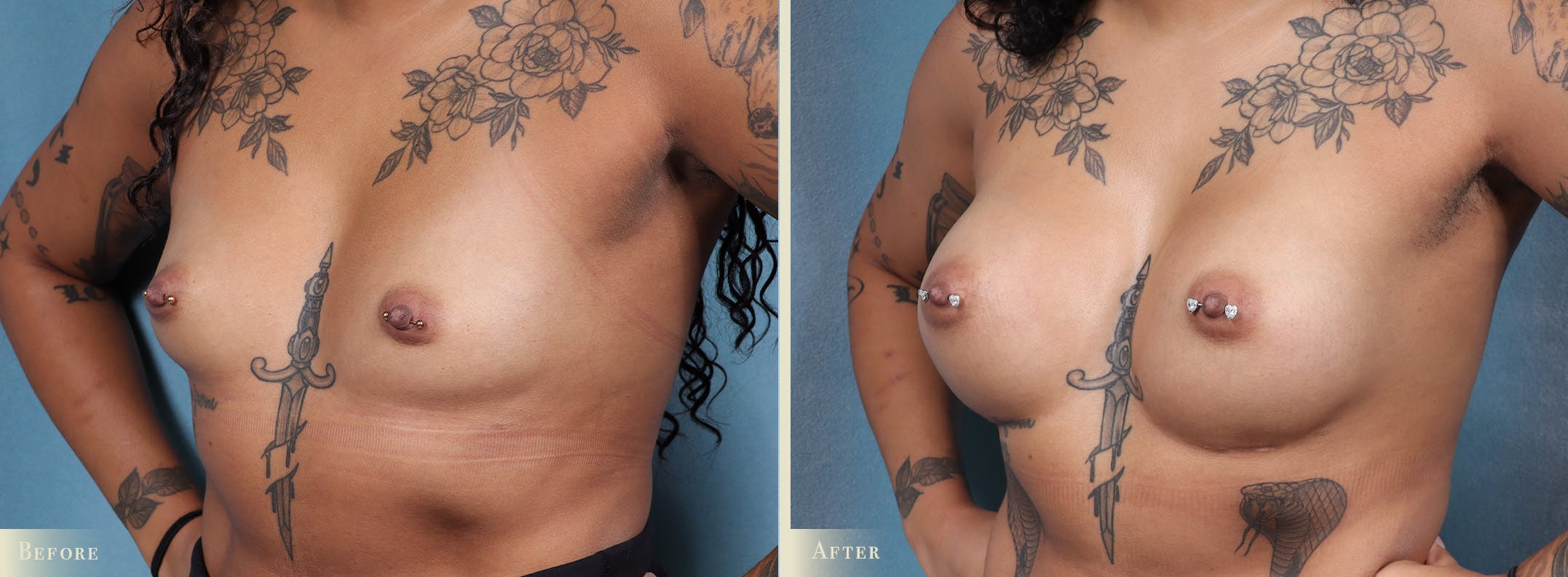 Breast Augmentation Before & After Gallery - Patient 127669 - Image 2