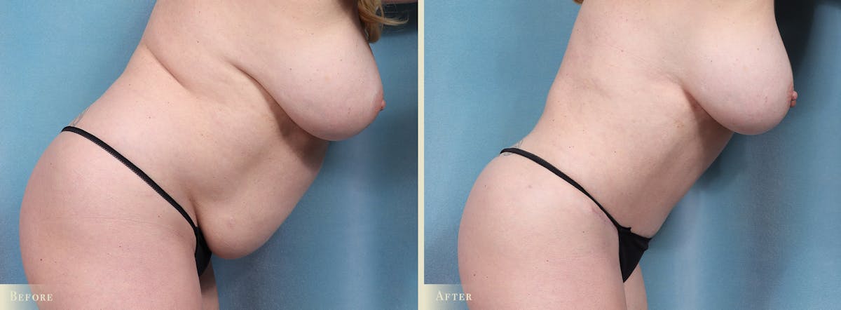Tummy Tuck Before & After Gallery - Patient 754046 - Image 2